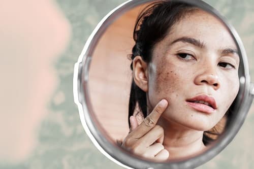 HAMİLELİKTE CİLT LEKELERİNE NE İYİ GELİR?