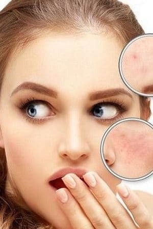 CİLT LEKELERİ NEDEN OLUŞUR?